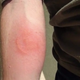 Image for article titled Man Gives Himself A Tattoo By Letting 1,000 Bed Bugs Feed On Him